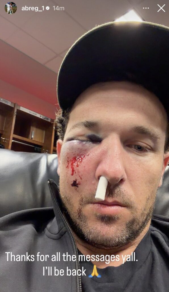 Injured baseball player with swollen eye and nasal packing
